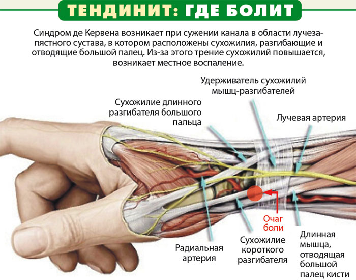 Тендинит: где болит